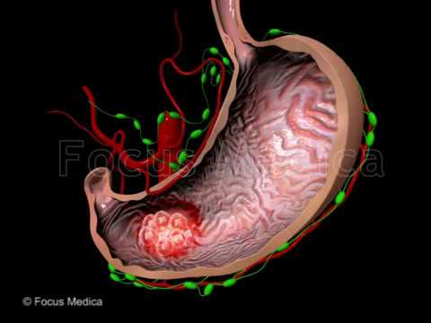 Maltoma Pathology Insights for Scientific Outreach