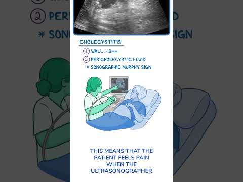 Radiological Insights into Acalculous Cholecystitis Diagnosis