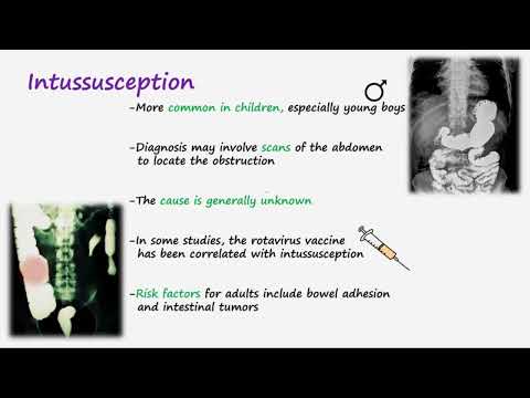 Intussusception Pathophysiology Unraveled Through Science