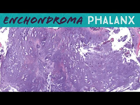 Enchondroma Pathology Insights and Research Developments