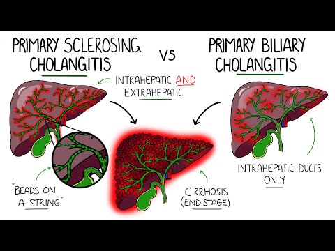 Radiological Insights into Cholangitis Diagnosis and Management