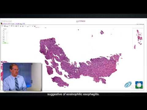 Barrett Esophagus Pathology: Scientific Insights and Implications