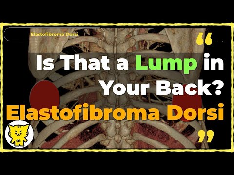 Elastofibroma Dorsi in Radiology: Imaging and Diagnosis Insights