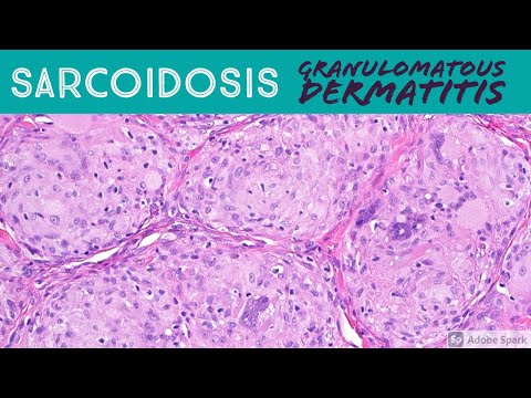 Sarcoidosis Histology: Insights into Granuloma Formation