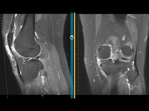 Advances in Radiology for Meniscal Tear Diagnosis