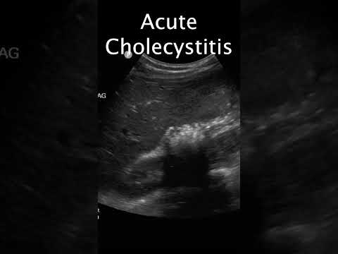 Radiological Advances in Diagnosing Chronic Cholecystitis