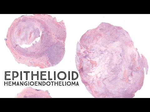 Epithelioid Hemangioendothelioma Pathology Insights and Findings