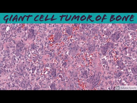 Giant Cell Tumor Pathology Frameworks and Insights
