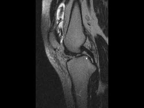 Radiological Insights into Pigmented Villonodular Synovitis