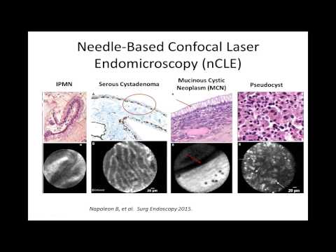 Advancements in IPMN Pathology and Its Clinical Implications